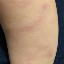 Northwest Medical Center - Bruising from medical staff holding down an infant (more pics taken as notes for experience)