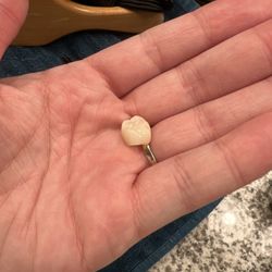 Inwood Village Dental - Tooth 18