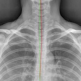 X-ray report by Dr Torrez X-ray report by Dr Torrez