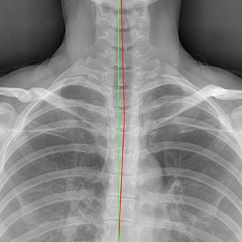 Zen Care Physical Medicine - X-ray report by Dr Torrez - Chiropractors Near Me - Irvine, California Zen Care Physical Medicine - X-ray report by Dr Torrez - Chiropractors Near Me - Irvine, California