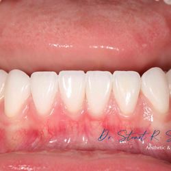 University Associates In Dentistry - Lower veneers, beautiful warmth, harmony, and natural appearance