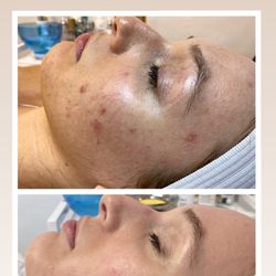 Sweet Skin by Gaby - Acne