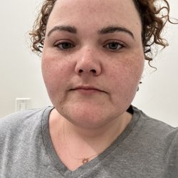 Lavender Med Spa - My skin right before Ultherapy