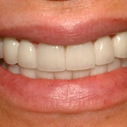 H Craig Froonjian, DMD - Pt. #5 after- full mouth reconstruction