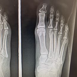 Right foot, 2nd metatarsal fracture, 5 1/2 weeks after initial injury and consult. Right foot, 2nd metatarsal fracture, 5 1/2 weeks after initial injury and consult.