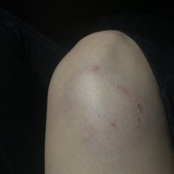 Central Community Police Station - Picture of my knee , night of on 4-9-23 . Tackled and assaulted and bit !
