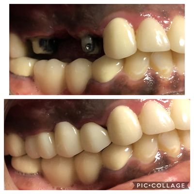 Full Porcelain Bridge Cases (Metal Free) - Full Porcelain Bridges in as little as 2 weeks!