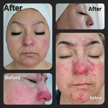 Signature Med Spa - You can FEEL my pain through these photos. These results are real. Book an appointment. - Medical Spas Near Me - Torrance, California Signature Med Spa - You can FEEL my pain through these photos. These results are real. Book an appointment. - Medical Spas Near Me - Torrance, California