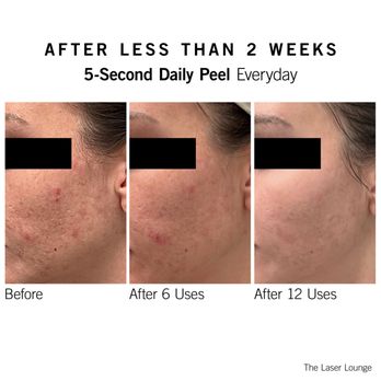Radiance Medspa - Neova Daily Peel Pads Results - Day Spas Near Me - West Chester, Pennsylvania Radiance Medspa - Neova Daily Peel Pads Results - Day Spas Near Me - West Chester, Pennsylvania