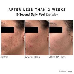 Radiance Medspa - Neova Daily Peel Pads Results