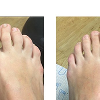 Global Podiatry - Cosmetic Nail Reconstruction - Podiatrists Near Me - Buffalo Grove, Illinois Global Podiatry - Cosmetic Nail Reconstruction - Podiatrists Near Me - Buffalo Grove, Illinois