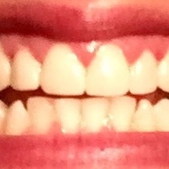 Pardo Dentistry - My new smile, gums a little raw (red) - Cosmetic Dentists Near Me - Glendora, California Pardo Dentistry - My new smile, gums a little raw (red) - Cosmetic Dentists Near Me - Glendora, California