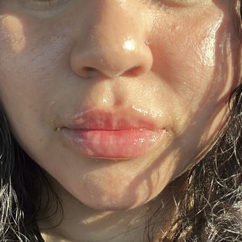 NakedMD - Riverside - Lip filler & Lip flip procedure, 1 hour after - Medical Spas Near Me - Riverside, California NakedMD - Riverside - Lip filler & Lip flip procedure, 1 hour after - Medical Spas Near Me - Riverside, California