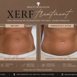 Beauty Bungalow Face and Body Sculpting - XERF abdomen skin tightening before & after. Non-surgical RF treatment to tighten loose skin with no downtime in Tustin, CA.