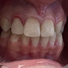 Dr Yang did this by hand and perfectly color matched. He and his team are true professionals! Dr Yang did this by hand and perfectly color matched. He and his team are true professionals!