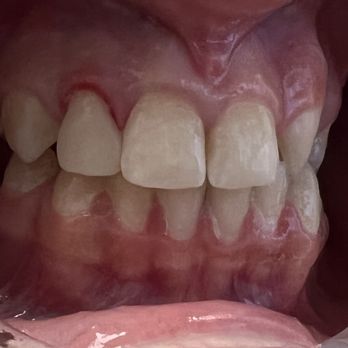 Michael Yang, DDS - Dr Yang did this by hand and perfectly color matched. He and his team are true professionals! - General Dentistry Near Me - Tustin, California Michael Yang, DDS - Dr Yang did this by hand and perfectly color matched. He and his team are true professionals! - General Dentistry Near Me - Tustin, California
