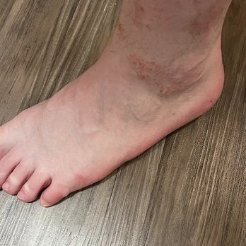 Smiley Nail Spa - Foot infection from the salon - Nail Salons Near Me - Walnut Creek, California