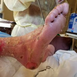 The small black dot on his heel is what the sore looked like when my Dad was admitted. The small black dot on his heel is what the sore looked like when my Dad was admitted.