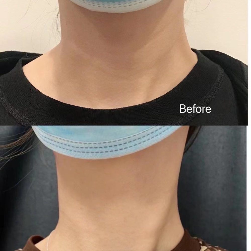 neckline treatment neckline treatment