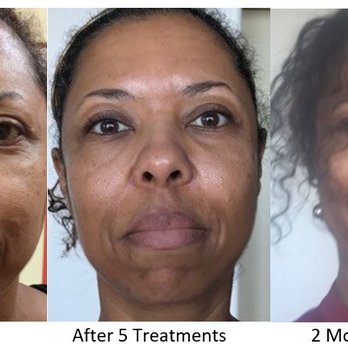 The Skin Studio - Laser Genesis Series - Skin Care Near Me - Oakland, California