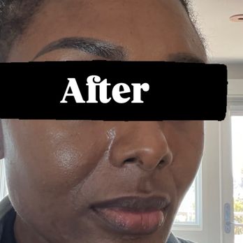 Acne Treatment SF - After her daily morning routine. 100% bare face just natural moisturizers. - Skin Care Near Me - San Francisco, California Acne Treatment SF - After her daily morning routine. 100% bare face just natural moisturizers. - Skin Care Near Me - San Francisco, California