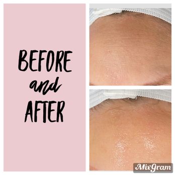 The Ft. Worth Aesthetician - Before and after deluxe Hydrafacial - Skin Care Near Me - Fort Worth, Texas The Ft. Worth Aesthetician - Before and after deluxe Hydrafacial - Skin Care Near Me - Fort Worth, Texas