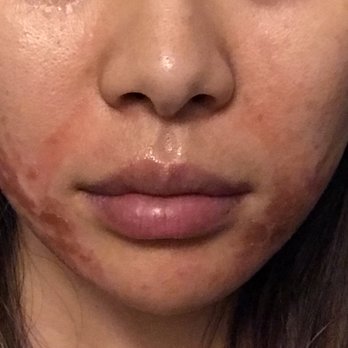 SkinSpirit - Seattle - 2 weeks after Ultherapy. Skin got hard and turned dark, and started peeling. New skin was still red. - Skin Care Near Me - Seattle, Washington SkinSpirit - Seattle - 2 weeks after Ultherapy. Skin got hard and turned dark, and started peeling. New skin was still red. - Skin Care Near Me - Seattle, Washington
