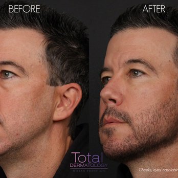 Total Dermatology - Patient was treated with filler in the cheeks, under the eyes, nasolabial folds, jawline and chin. - Dermatologists Near Me - Irvine, California