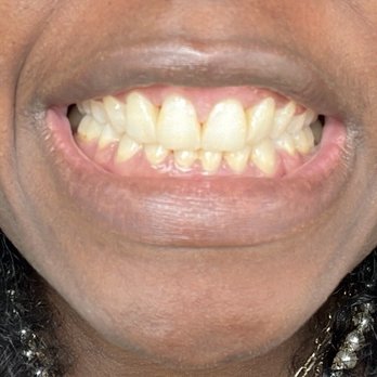Care Orthodontics - After - Orthodontists Near Me - San Jose, California Care Orthodontics - After - Orthodontists Near Me - San Jose, California