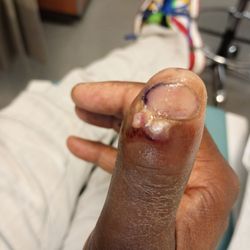 Doctors Medical Center - Not dirt. Violet. My tissue exploding out an incision too deep & in the wrong place!!!