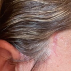 Michael A Epstein, MD - Noticeable and large scar from cheek lift, some call this procedure a mid facelift
