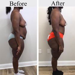 Orland Park Plastic Surgery - Before and after
Procedure: Tummy Tuck (Abdominoplasty)