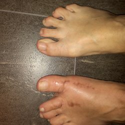 Franklin Foot Care of Rhode Island - Dr. Swineford did this . He messed up my foot bad. Do not go to him, he will ruin your life.