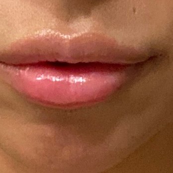 Frontier Dermatology Aesthetics - A few hours after... - Skin Care Near Me - Mill Creek, Washington