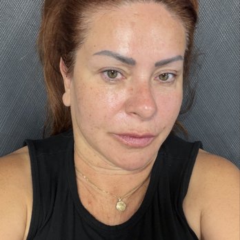 Grey Aesthetics  - This is my photo after a workout in full lighting. (No TriLift) - Skin Care Near Me - Newport Beach, California