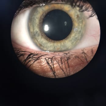 Blink Optometric - Up close photo of my eyeball!!! :-D - Optometrists Near Me - Walnut Creek, California