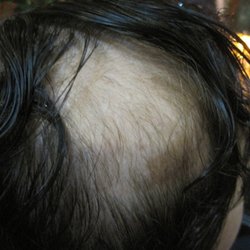 Headhunters Hair Designs - A bald patch we grew back with our treatments products tools and top piece