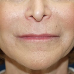 Jeffrey S. Rosenthal, M.D. - Rosenthal Liquid Facelift: After 55 year old.  Radiesse for cheeks and jaw & Juvederm around the mouth.