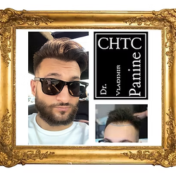 PANINE, MD - Chicago Hair Transplant Clinic - Before and after a hair transplant surgery in Chicago performed by Dr. Panine who is the best hair transplant surgeon in Illinois.