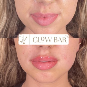 Glow Bar GNV - Lip Filler and PDO threads for Smile Lines - Aestheticians Near Me - Gainesville, Florida