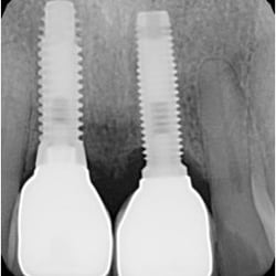 Colin M Day - Two implants and two new crowns
