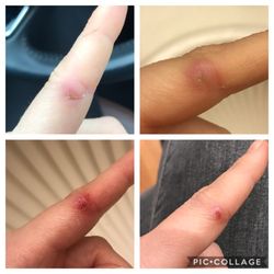 MedExpress Urgent Care - Week 2, 3, 4, and the day after I personally removed the "splinter" left in the cut. (Finally healing)