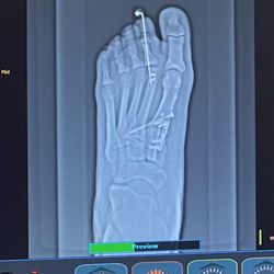 North Central Texas Foot & Ankle - X-ray post surgery