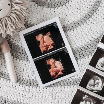 Eclipse 4D Mobile Ultrasounds - Ultrasound Imaging Centers Near Me Eclipse 4D Mobile Ultrasounds - Ultrasound Imaging Centers Near Me