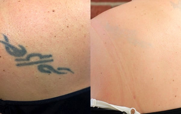 REMOVERY TATTOO REMOVAL & FADING - Updated May 2025 - 61 Photos & 74 ...