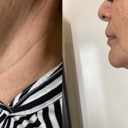 Synergy Skincare - Neck Tightening Treatment Folsom CA