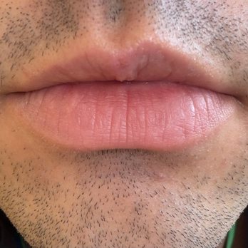 SoCal Skin and Surgery - 1 week after surgery. - Dermatologists Near Me - Los Angeles, California SoCal Skin and Surgery - 1 week after surgery. - Dermatologists Near Me - Los Angeles, California