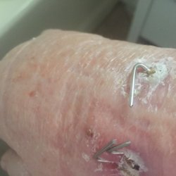 STANTON PAUL MD
