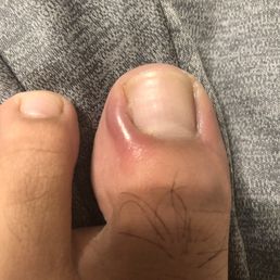 in a huge amount of pain and I'm oozing puss out of that area this happened all after I got a pedicure there. Will be requesting a refund. in a huge amount of pain and I'm oozing puss out of that area this happened all after I got a pedicure there. Will be requesting a refund.