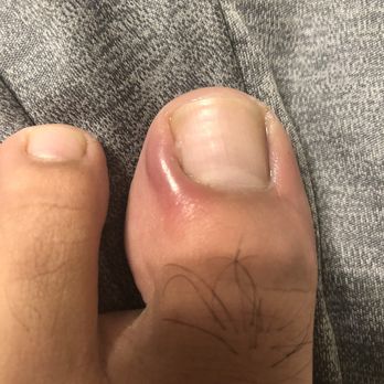 Perfect Ten Nail & Spa - in a huge amount of pain and I'm oozing puss out of that area this happened all after I got a pedicure there. Will be requesting a refund. - Nail Salons Near Me - Allen, Texas Perfect Ten Nail & Spa - in a huge amount of pain and I'm oozing puss out of that area this happened all after I got a pedicure there. Will be requesting a refund. - Nail Salons Near Me - Allen, Texas